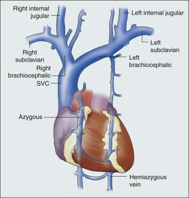 picc in innominate vein